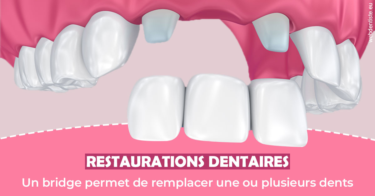 https://www.cabinetdentairemistralmazarin.fr/Bridge remplacer dents 2
