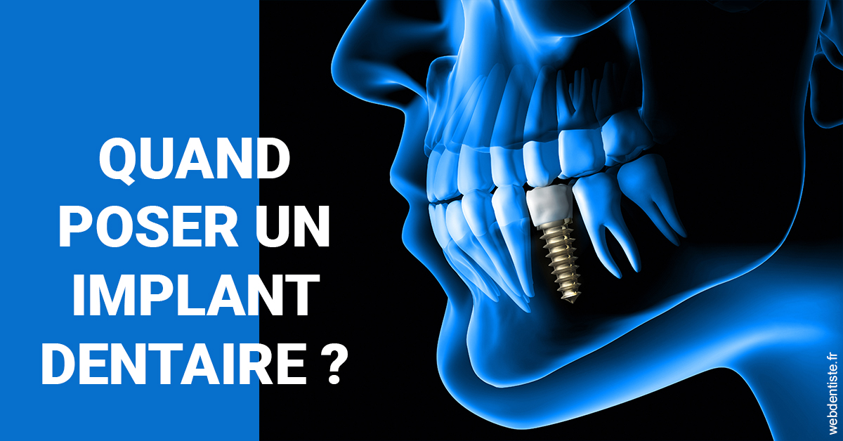 https://www.cabinetdentairemistralmazarin.fr/Les implants 1