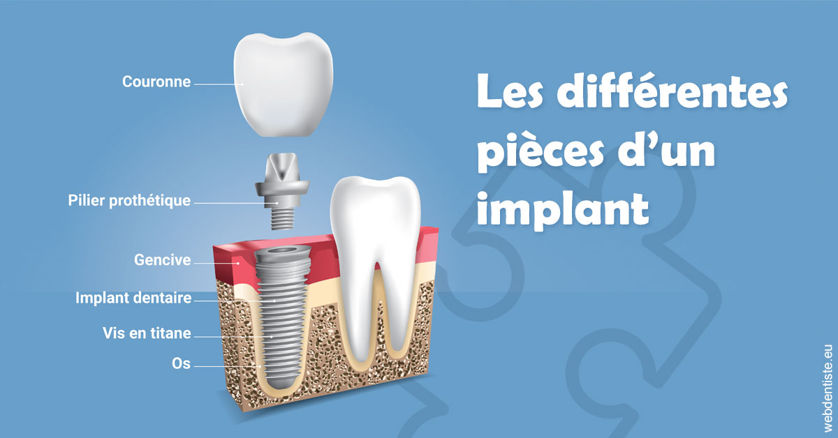 https://www.cabinetdentairemistralmazarin.fr/Les différentes pièces d’un implant 1